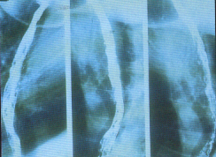 xray of yeast in esophagus